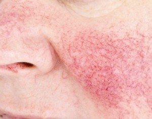 Couperose behandeling