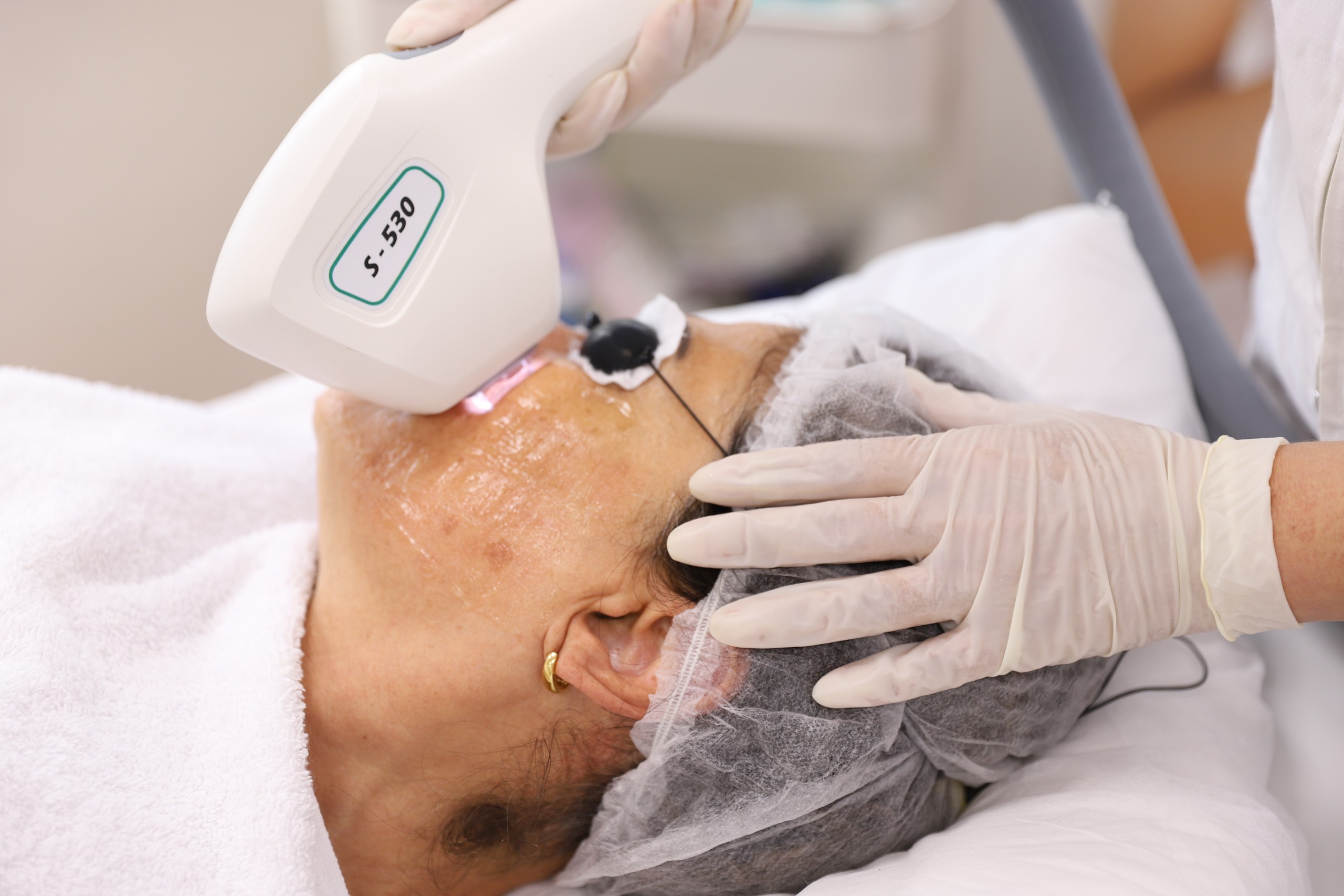 3D IPL (HUIDVERJONGING, PIGMENT, COUPEROSE) Pigment laserbehandeling