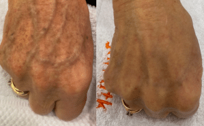 handen pigment laseren