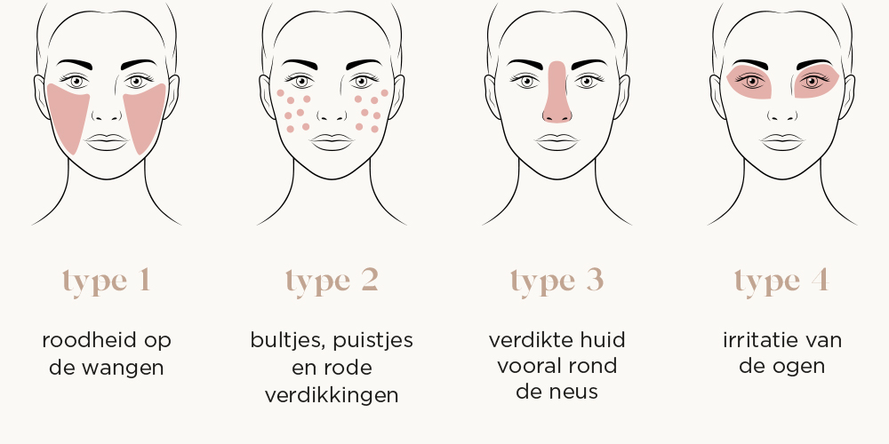 rosacea behandelen