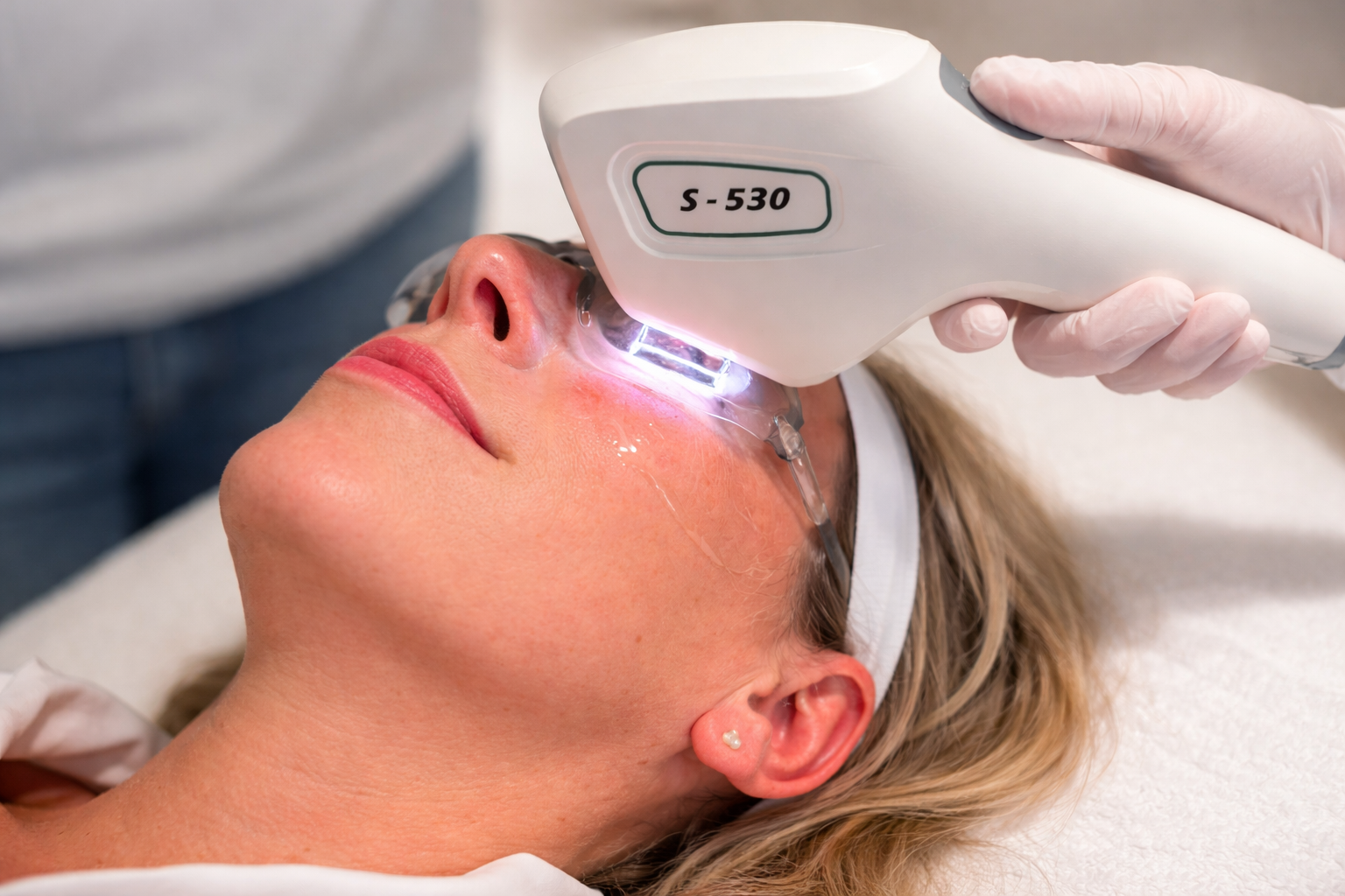 couperose laser behandeling nuenen