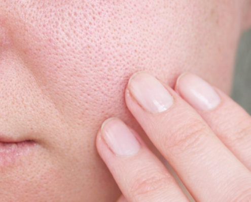 Hoe kan ik mijn poriën kleiner maken