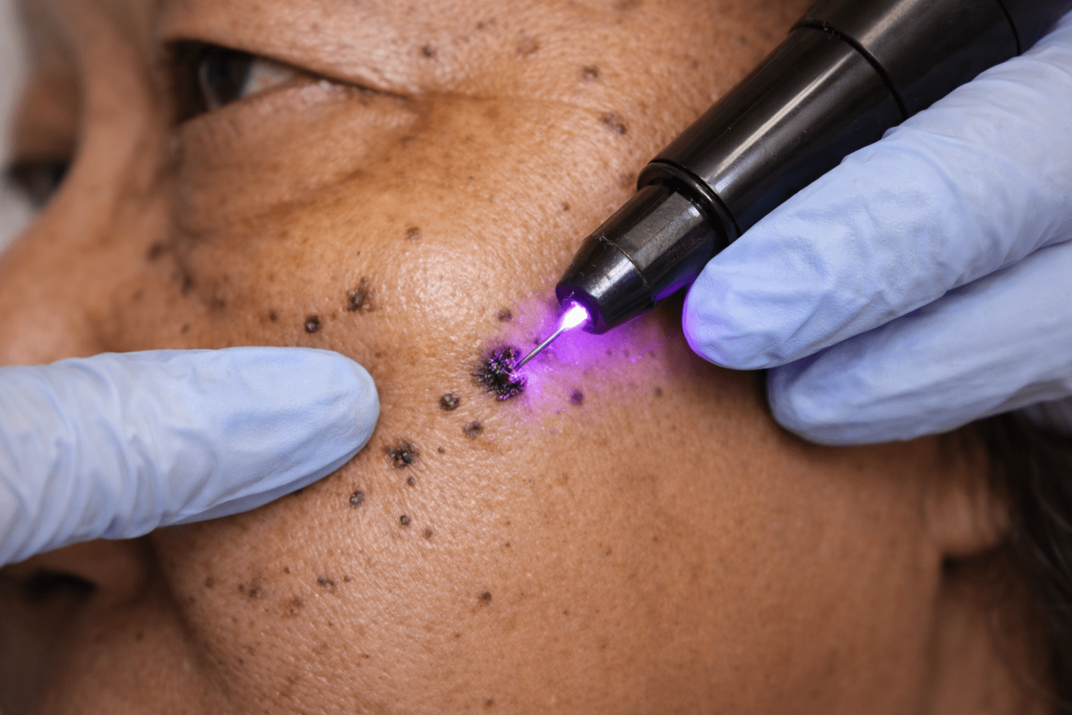 Dermatosis papulosa nigra (2)