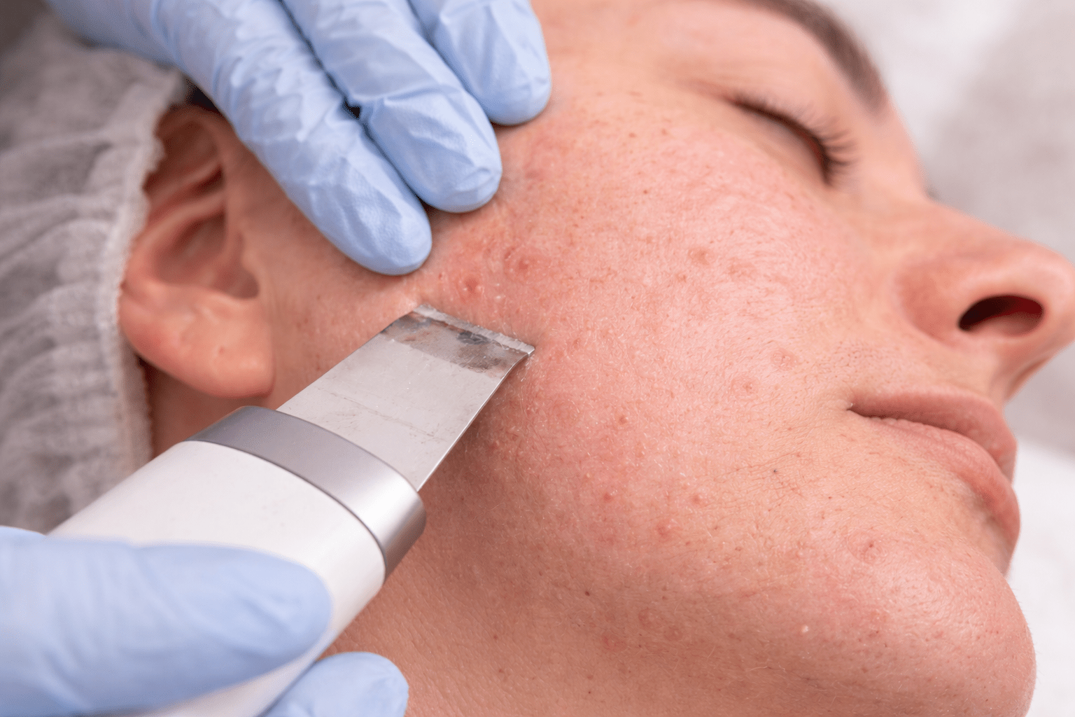 Huidbehandeling tegen acne en ontsteking happy skin