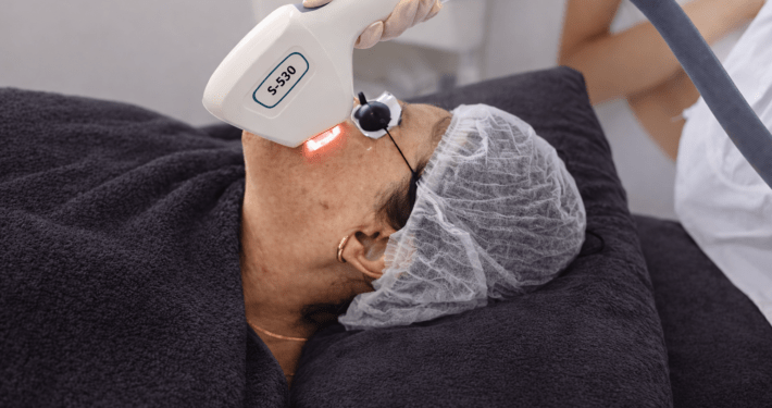 IPL PIGMENTBEHANDELING IPL PIGMENTBEHANDELING