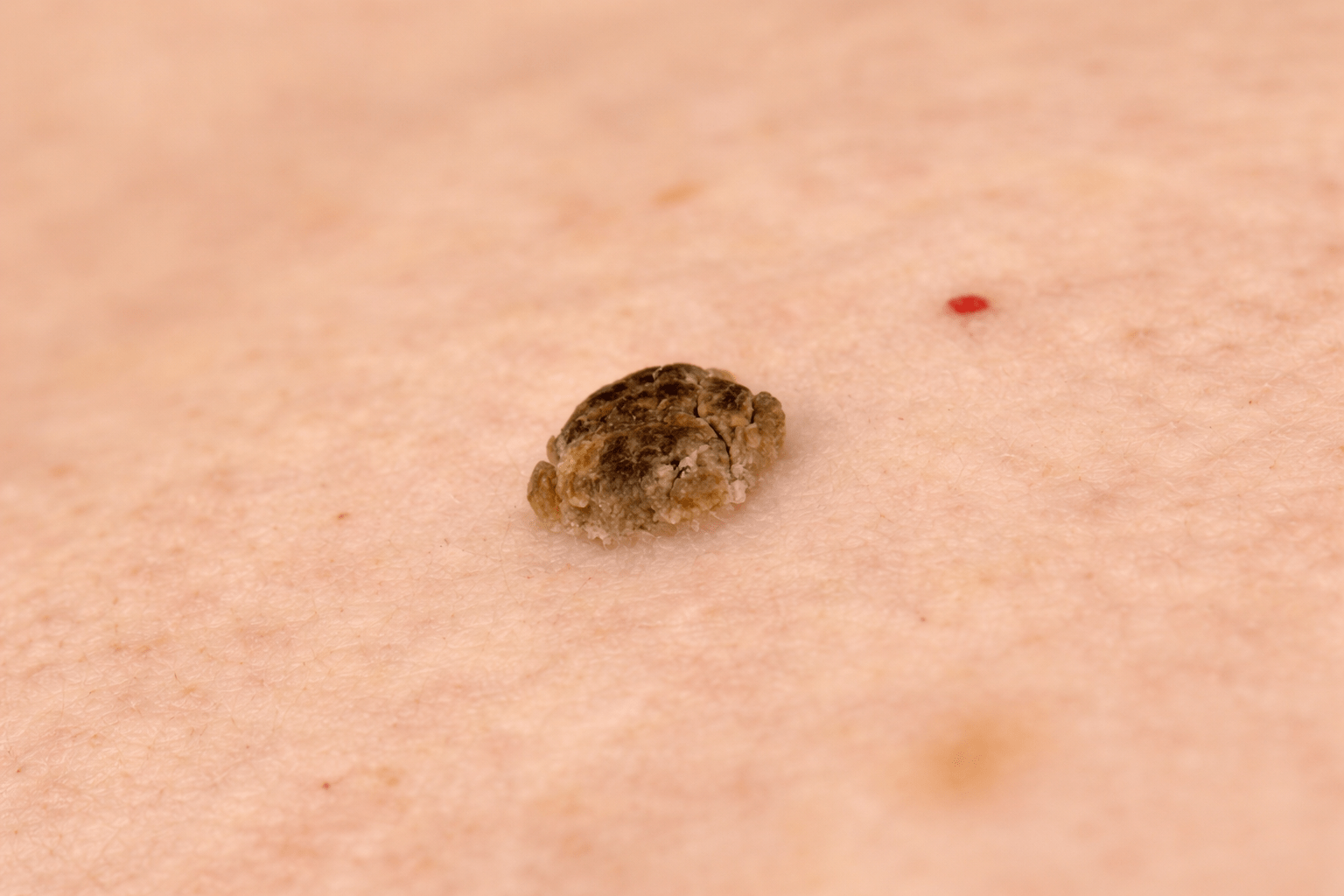 couperose behandeling nuenen