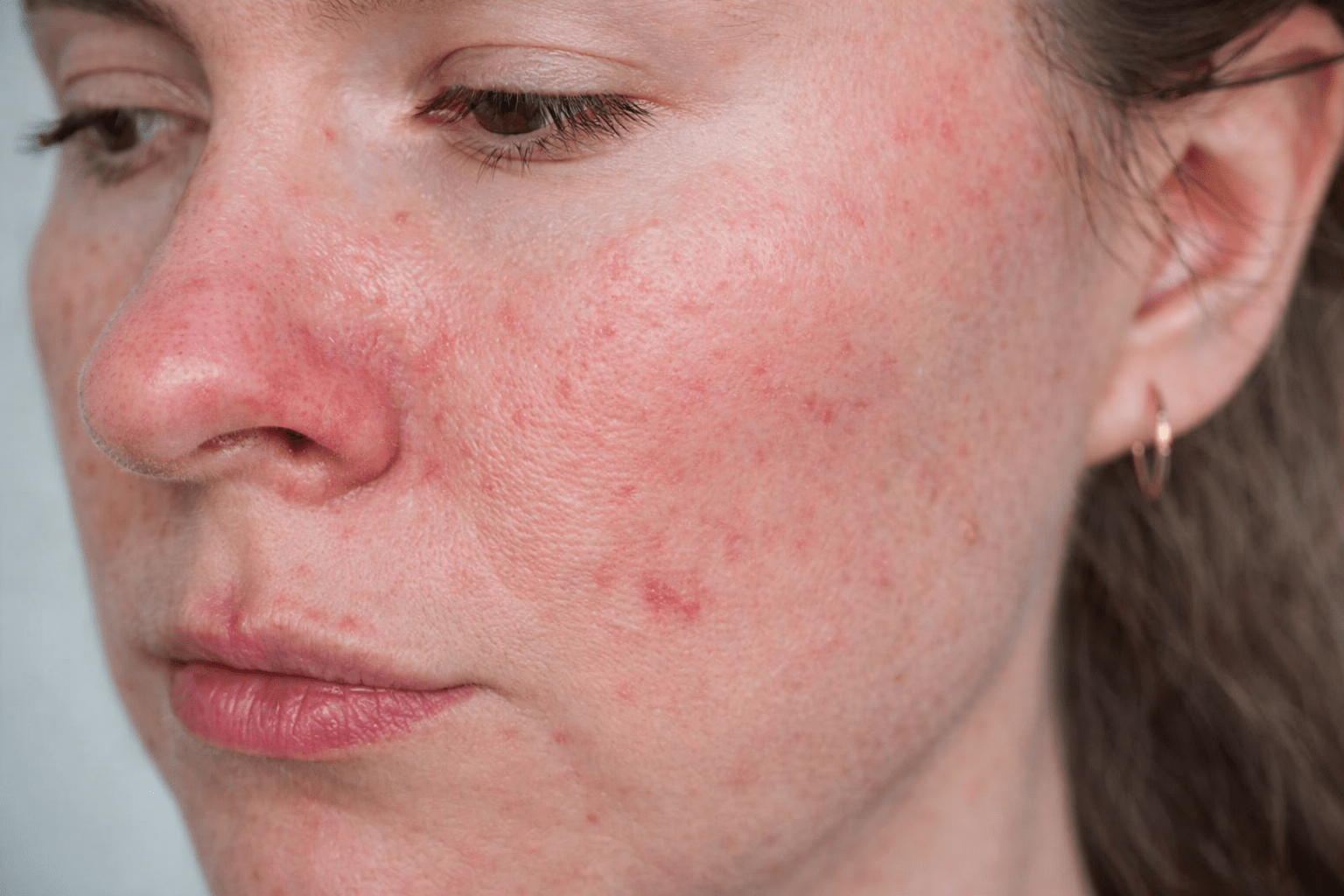 rosacea nuenen happy skin