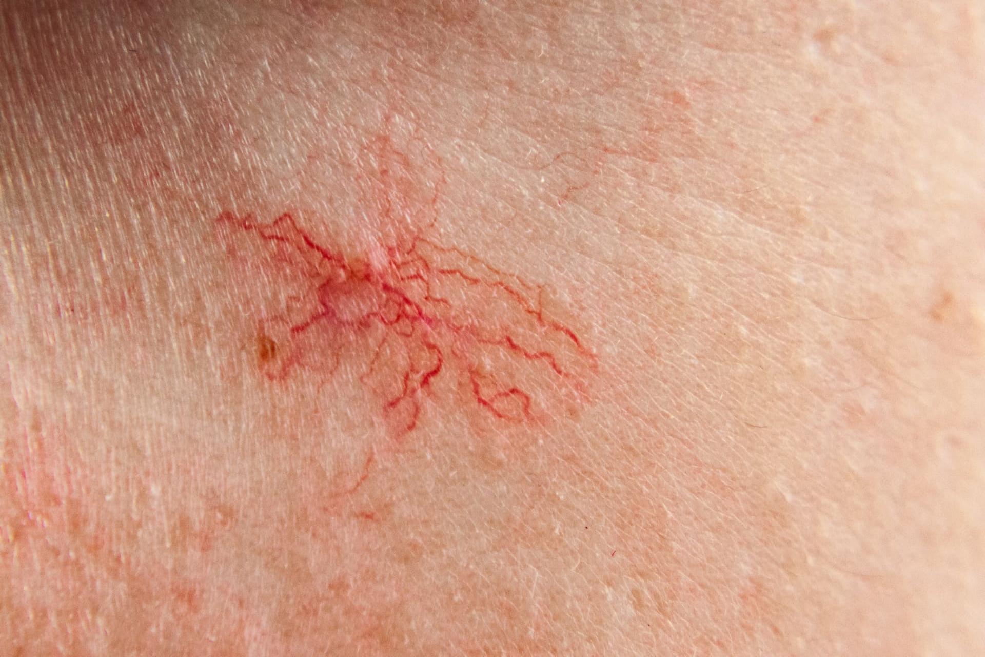 Een spider naevus (spinnenkopje)