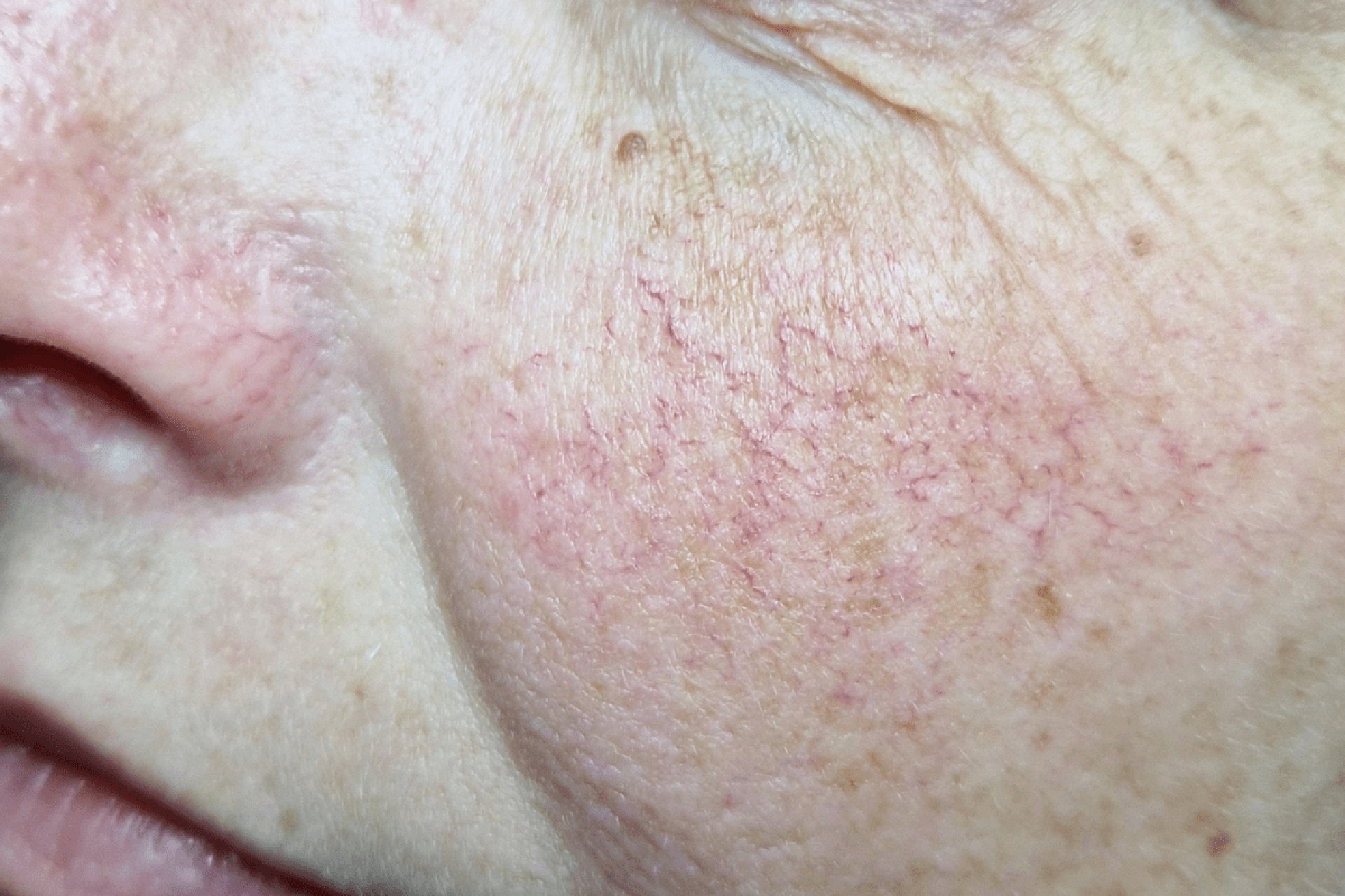 couperose nuenen happy skin