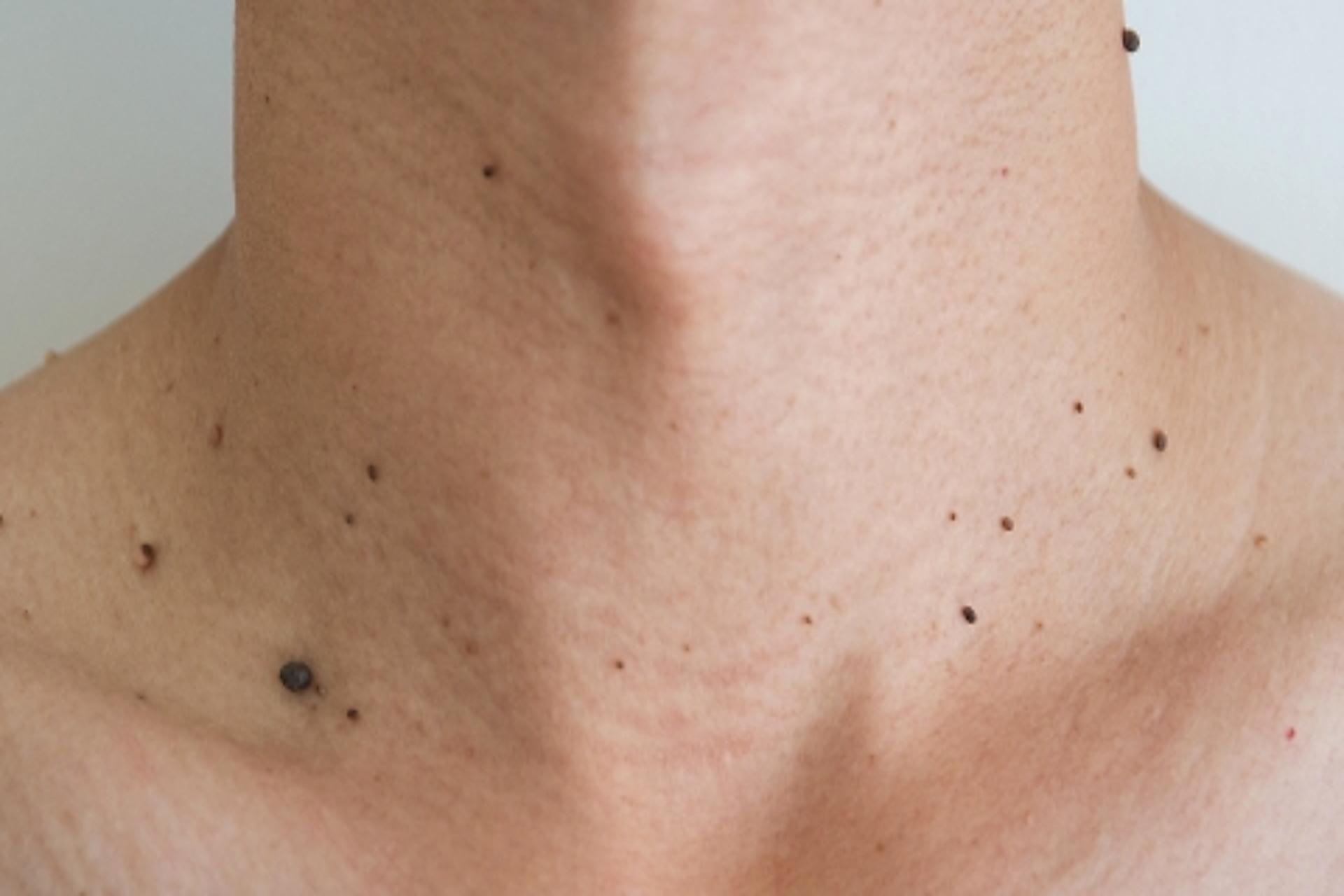 huidoneffenheden fibromen-steelwratjes