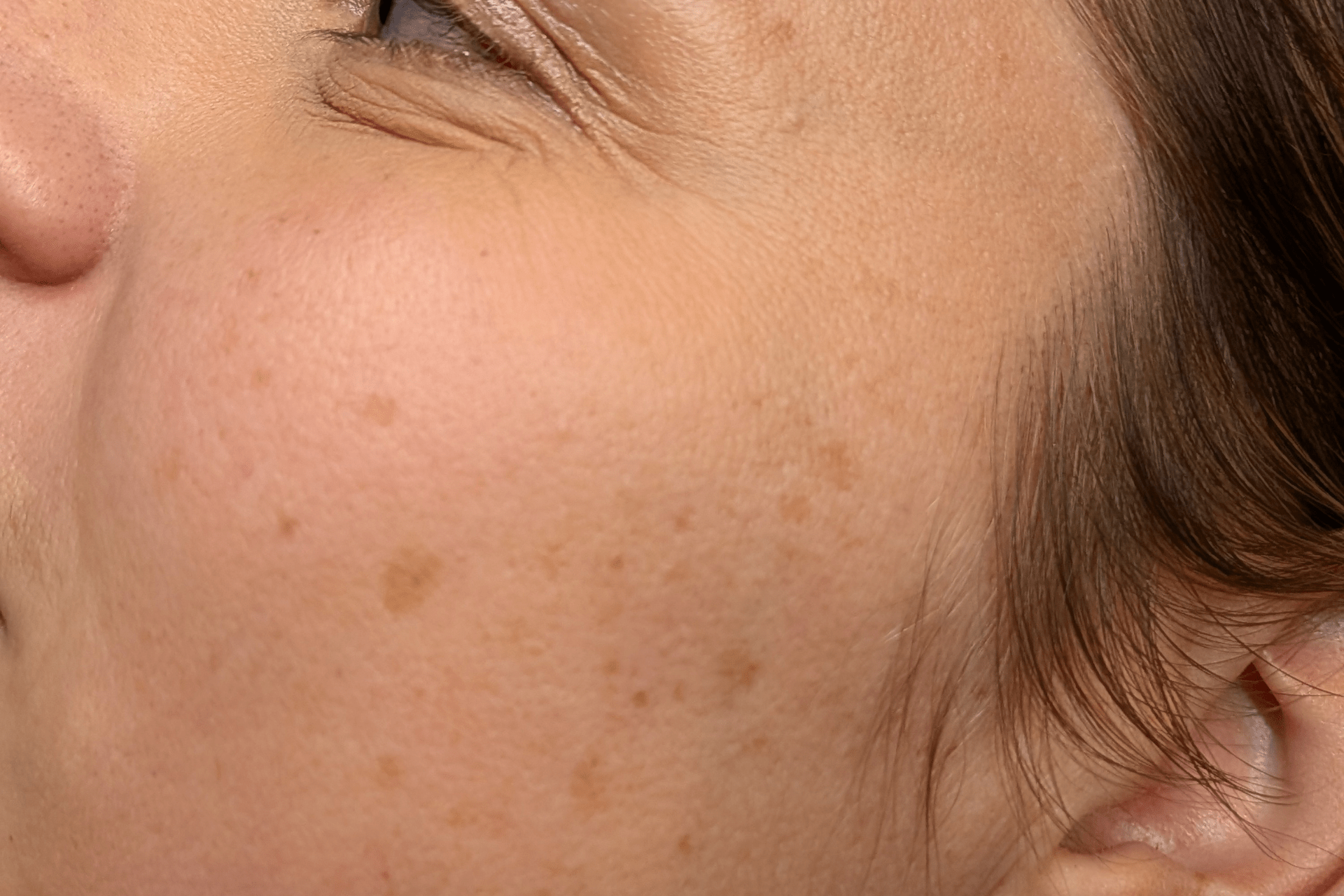 ipl pigment behandeling