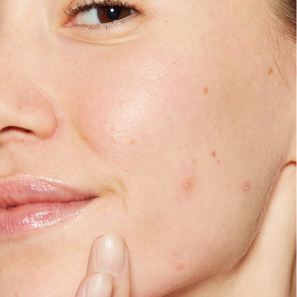 Plaatselijke toepassing van Dermalogica Deep Breakout Liquid Patch op de wang